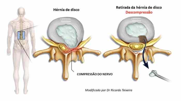 5 ideias de títulos:
1. Guia Completo: Recuperação Pós-Cirurgia de Hérnia de Disco
2. O Que Esperar Após a Cirurgia de Hérnia de Disco: Um Cronograma Detalhado
3. Dicas Essenciais para o Pós-Operatório de Hérnia de Disco
4. Retorno às Atividades Após Cirurgia de Hérnia de Disco: Passo a Passo
5. Hérnia de Disco: Cuidados Essenciais e Recuperação a Longo Prazo