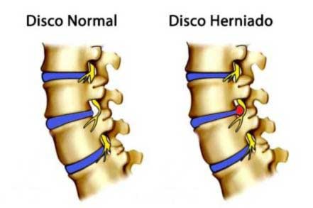 5 ideias de títulos:
1. Guia Completo: Recuperação Pós-Cirurgia de Hérnia de Disco
2. O Que Esperar Após a Cirurgia de Hérnia de Disco: Um Cronograma Detalhado
3. Dicas Essenciais para o Pós-Operatório de Hérnia de Disco
4. Retorno às Atividades Após Cirurgia de Hérnia de Disco: Passo a Passo
5. Hérnia de Disco: Cuidados Essenciais e Recuperação a Longo Prazo
