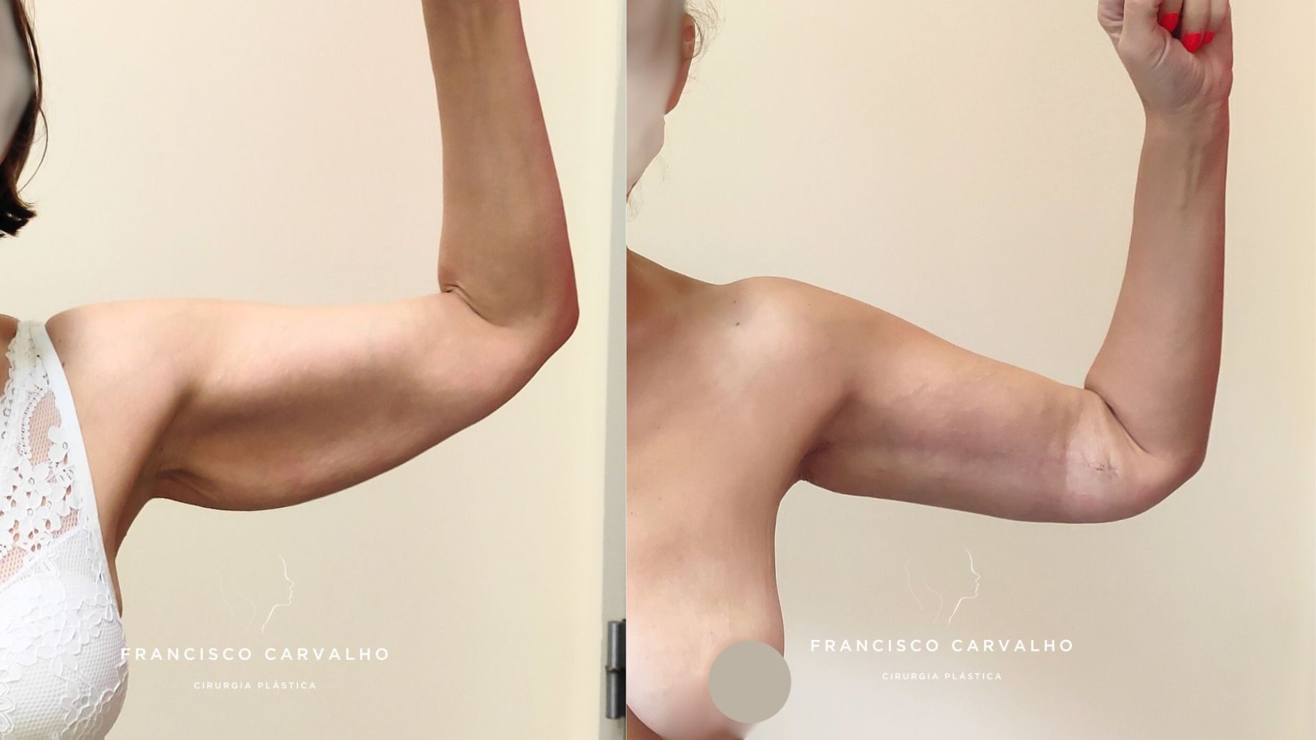 Braquioplastia Antes E Depois