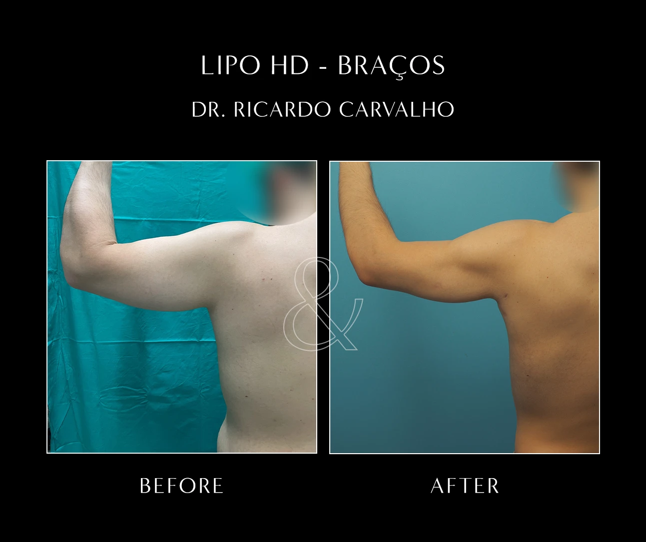 Braquioplastia Antes E Depois