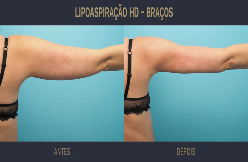 Braquioplastia Antes E Depois