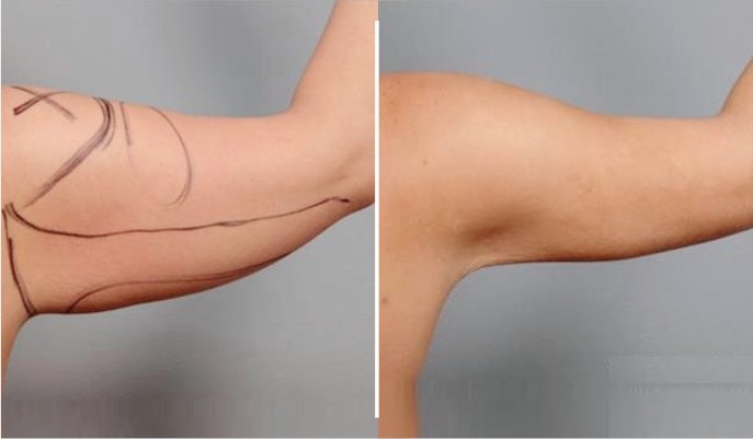 Braquioplastia Antes E Depois