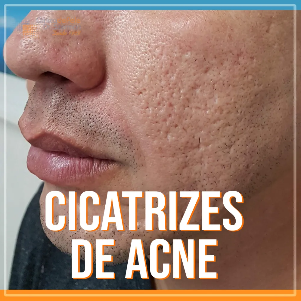 Como Tirar Manchas E Cicatrizes De Espinhas Do Rosto