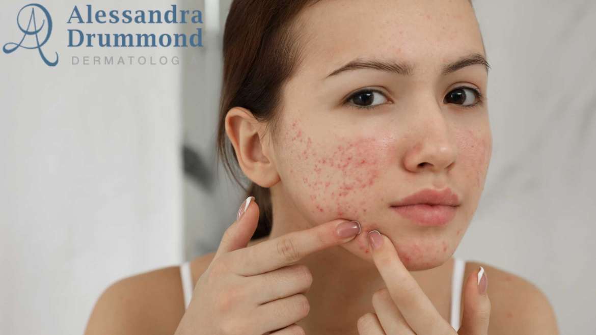 Os Melhores Ativos Clareadores para Manchas de Acne: Guia Completo