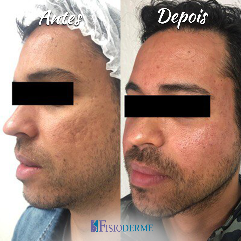 Microagulhamento ou Laser Fracionado: Qual o Melhor para Suas Cicatrizes de Acne?