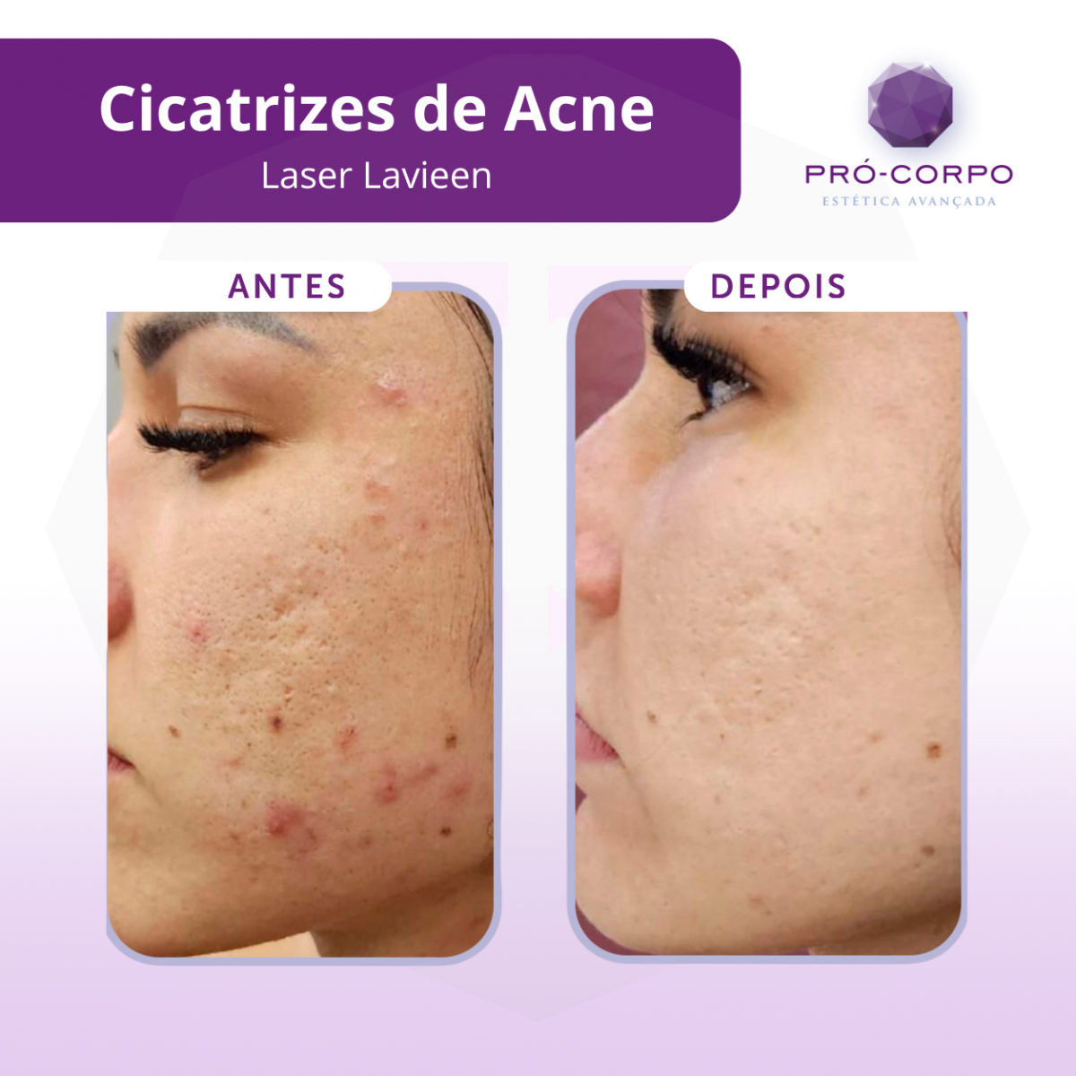 Hidroquinona e Retinoides: Como Usar com Segurança no Tratamento da Acne
