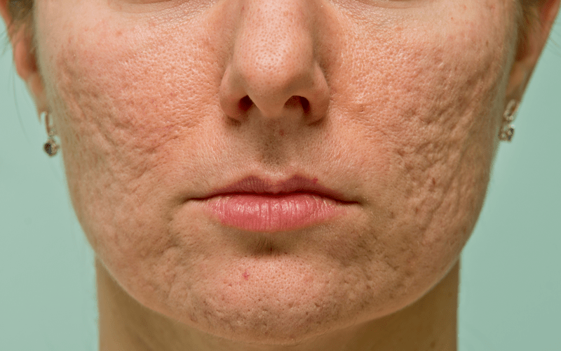 Rotina de Skincare Essencial para Prevenir Manchas e Cicatrizes de Espinhas