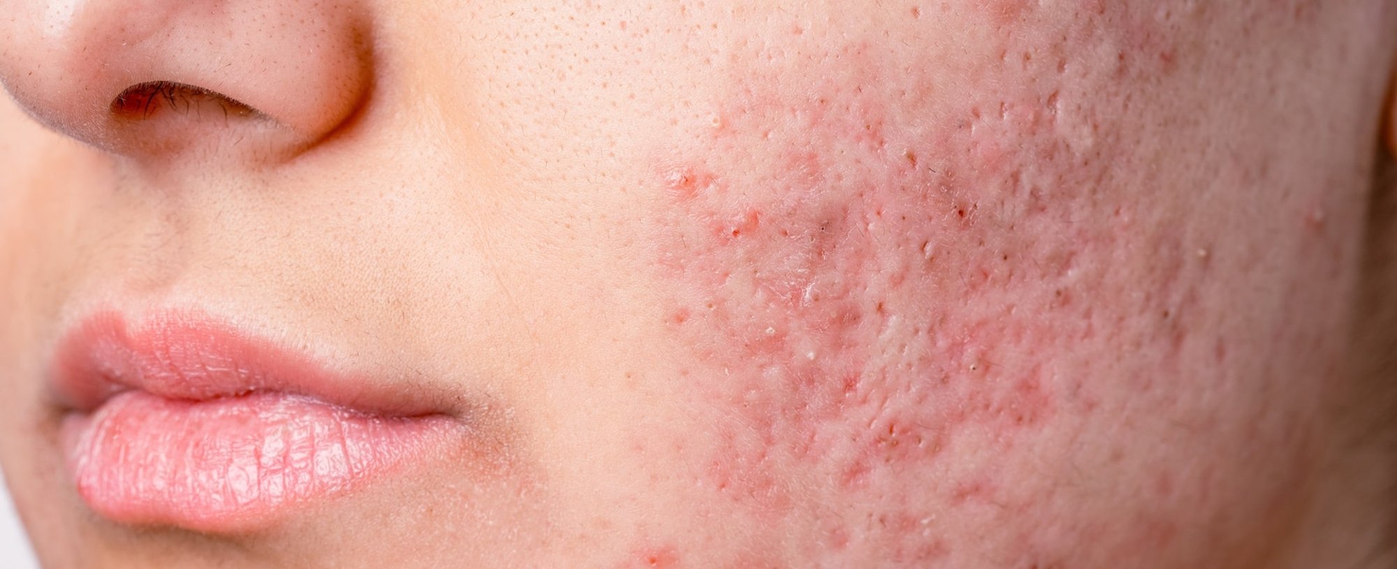 Tipos de Cicatrizes de Acne e Seus Tratamentos Específicos: Um Guia Dermatológico