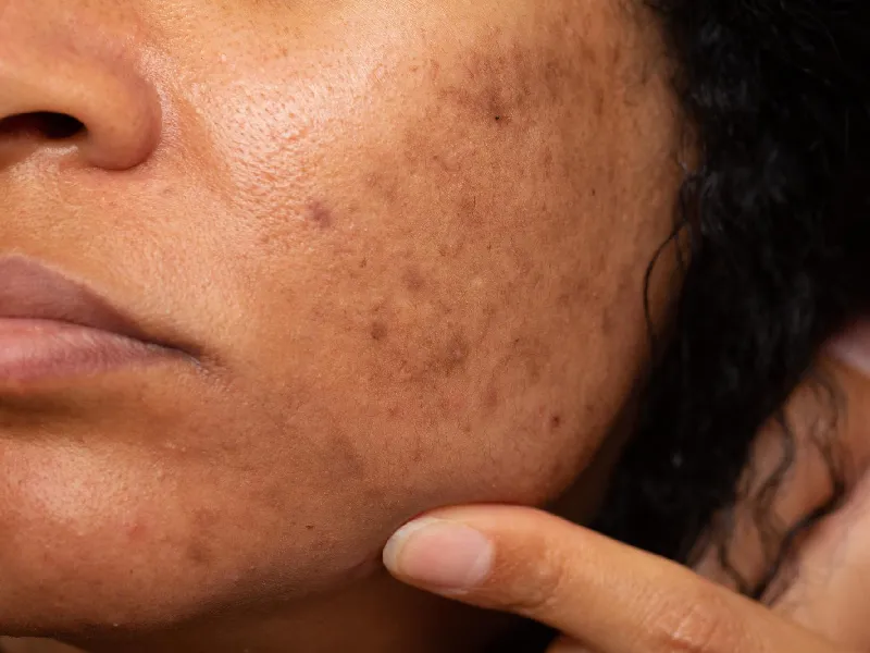 Os Melhores Ativos Clareadores para Manchas de Acne: Guia Completo