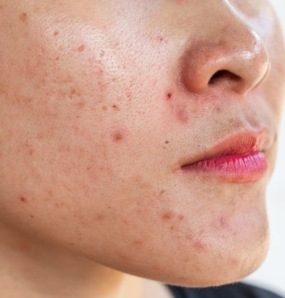 Microagulhamento ou Laser Fracionado: Qual o Melhor para Suas Cicatrizes de Acne?
