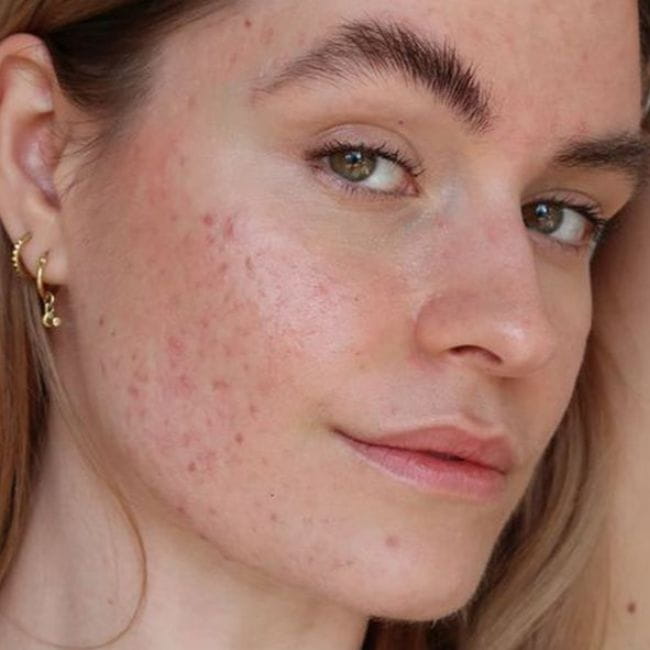 Hidroquinona e Retinoides: Como Usar com Segurança no Tratamento da Acne