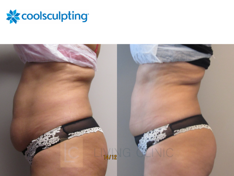 Criolipólise Antes E Depois