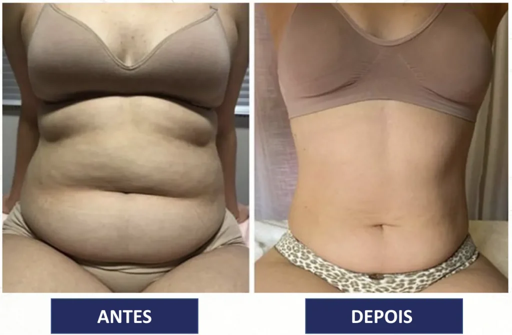 Criolipólise: O Guia Completo para Resultados Duradouros