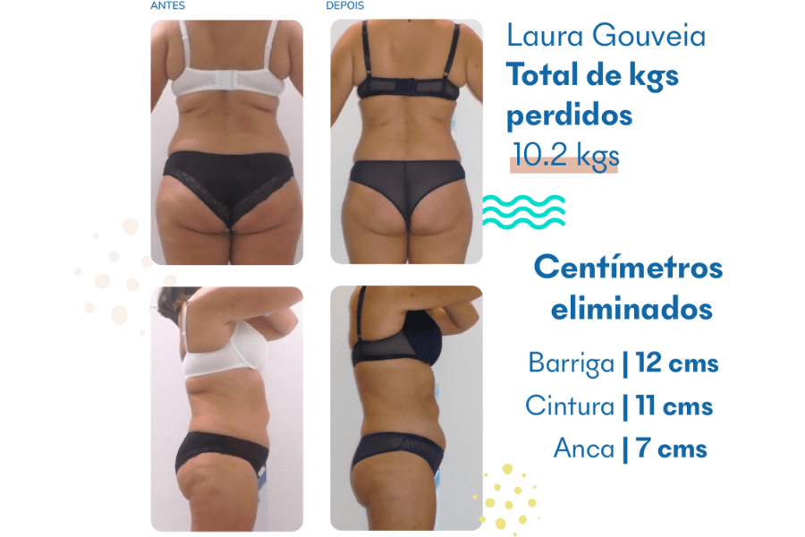 Criolipólise na Papada: Tudo sobre o Procedimento e Resultados