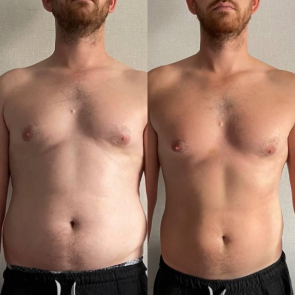 Criolipólise Antes E Depois