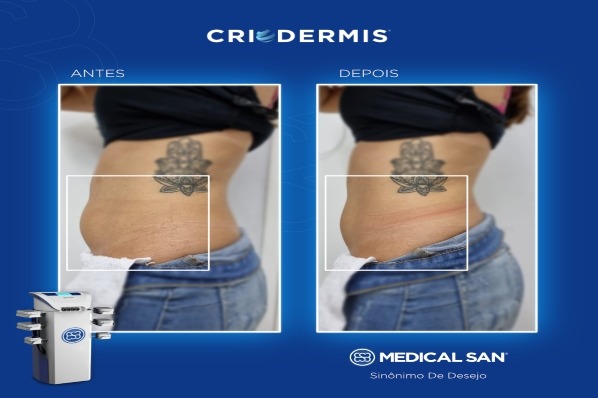 Criolipólise: O Guia Completo para Resultados Duradouros