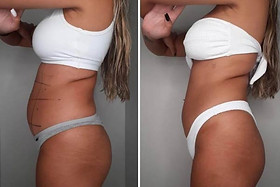 Mitos e Verdades sobre a Criolipólise: O que Você Precisa Saber