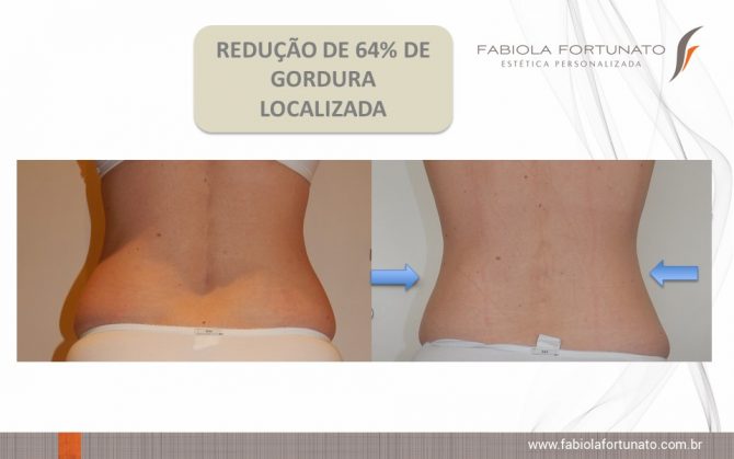 Pós-Criolipólise: Cuidados Essenciais para Potencializar seu Tratamento