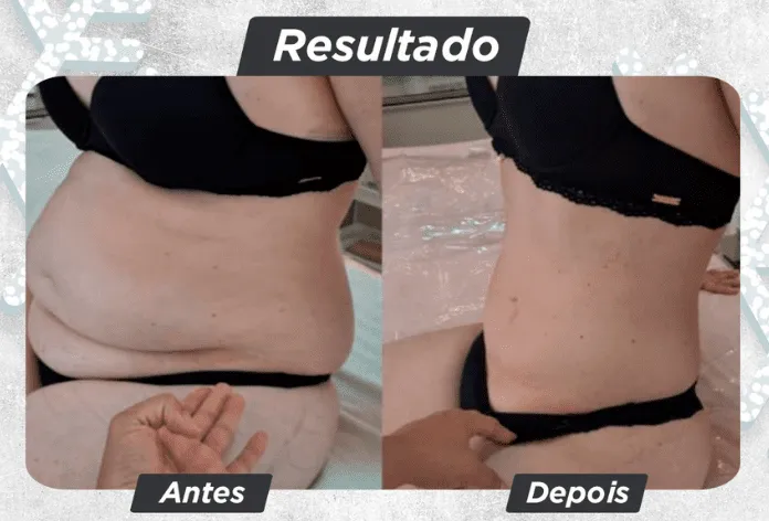 Criolipólise vs. Outros Tratamentos para Gordura Localizada: Qual Escolher?