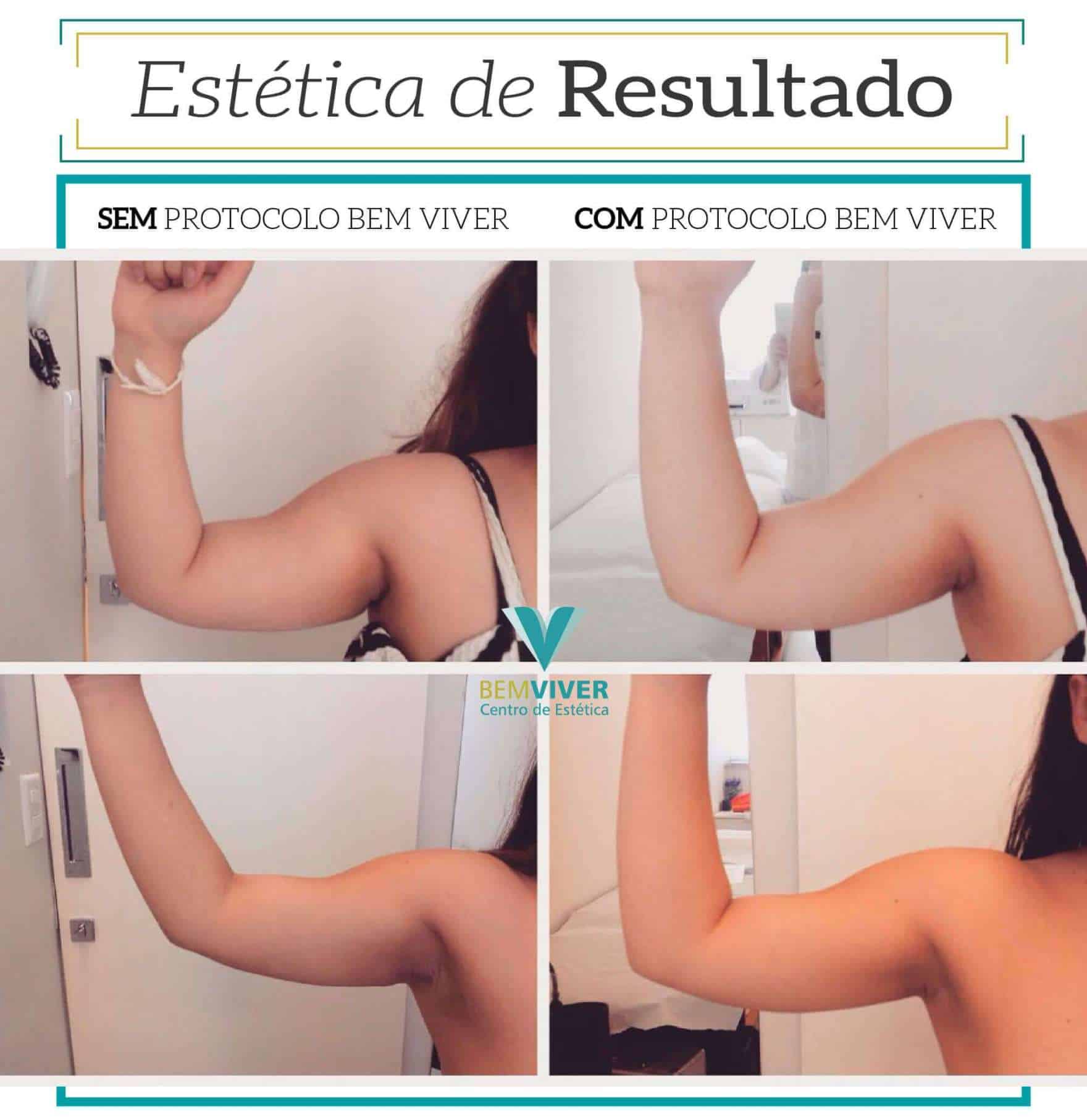 Criolipólise na Papada: Tudo sobre o Procedimento e Resultados