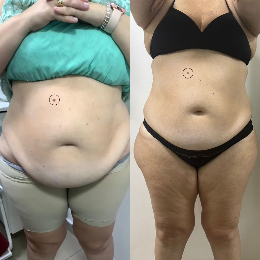 Criolipólise Antes E Depois