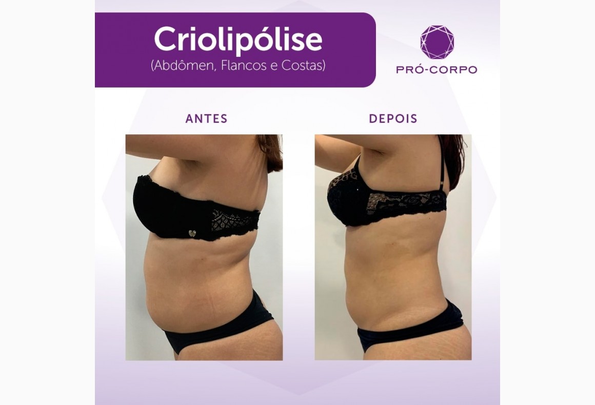 Criolipólise: O Guia Completo para Resultados Duradouros
