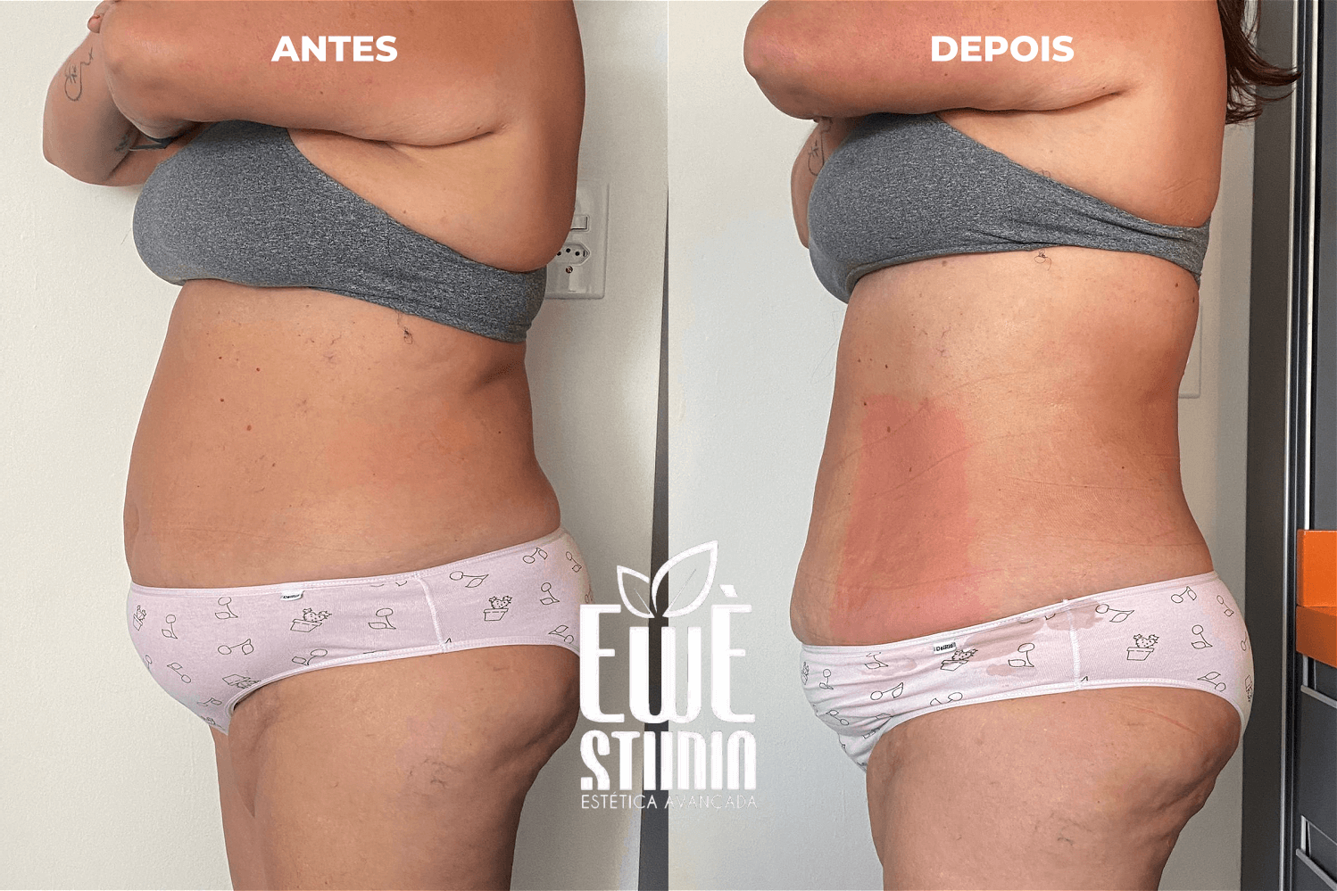 Mitos e Verdades sobre a Criolipólise: O que Você Precisa Saber