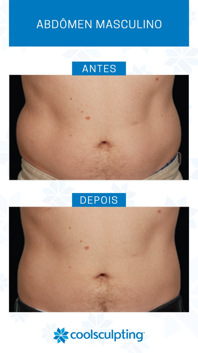 Pós-Criolipólise: Cuidados Essenciais para Potencializar seu Tratamento