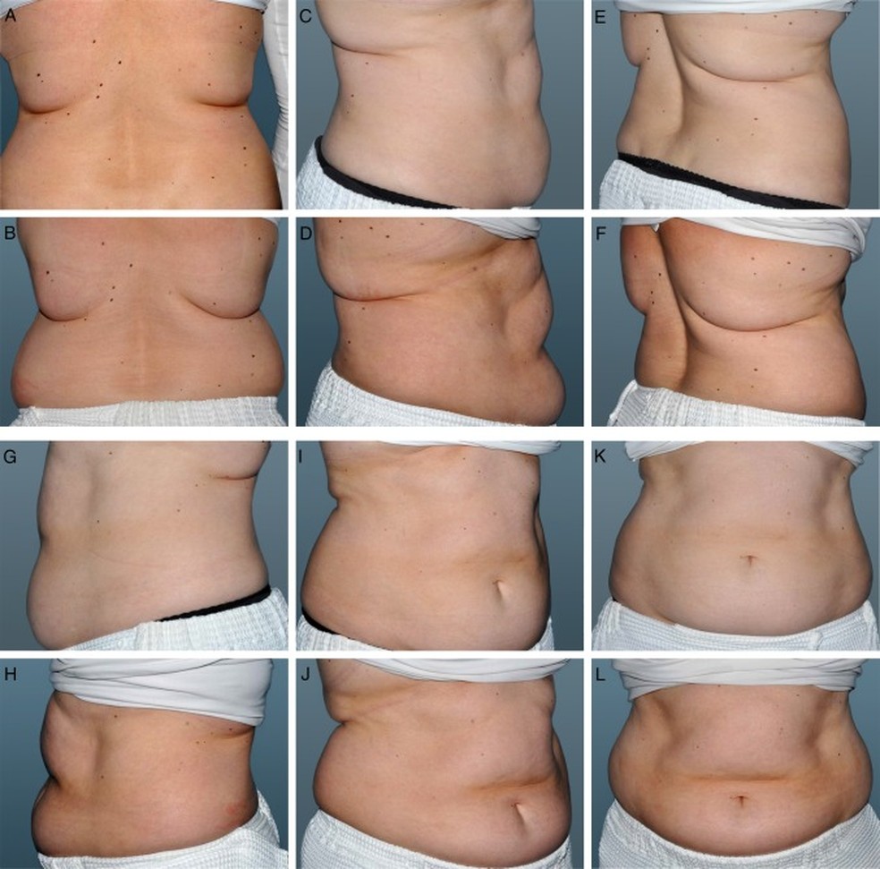 Criolipólise Antes E Depois