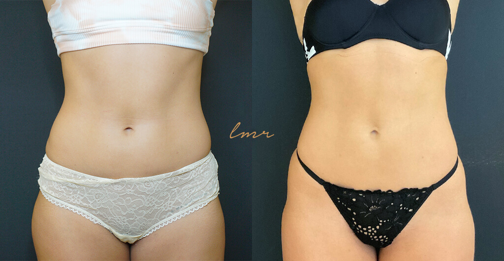 Pós-Criolipólise: Cuidados Essenciais para Potencializar seu Tratamento