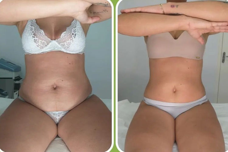 Criolipólise vs. Outros Tratamentos para Gordura Localizada: Qual Escolher?