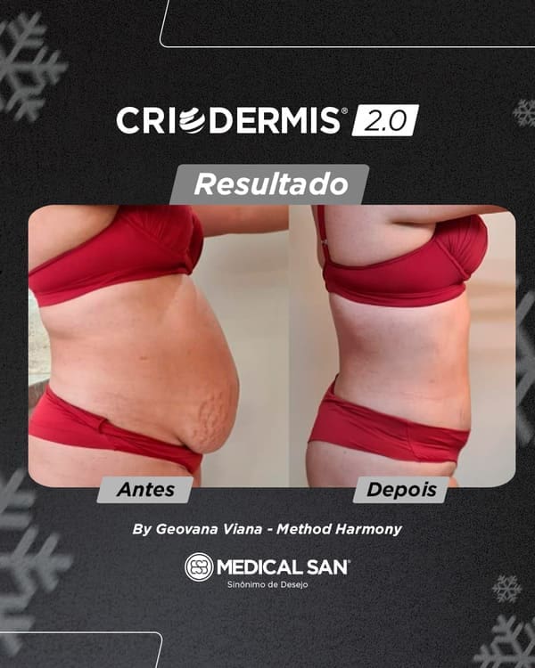 Criolipólise na Papada: Tudo sobre o Procedimento e Resultados