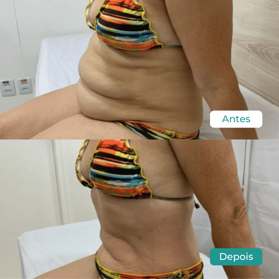 Criolipólise Antes E Depois