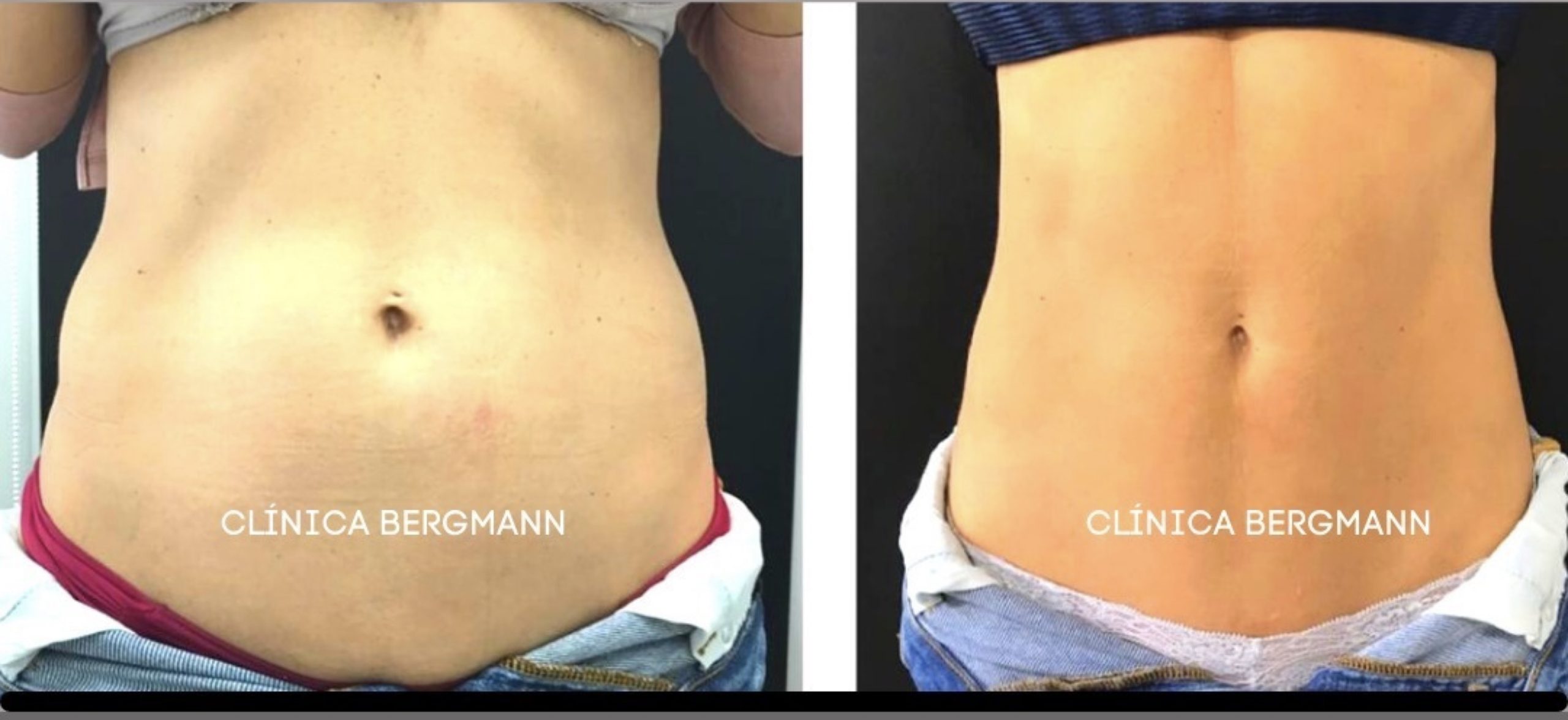 Criolipólise: O Guia Completo para Resultados Duradouros