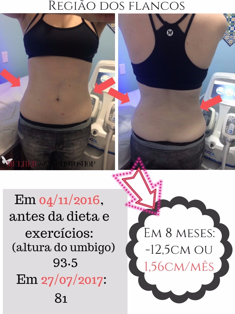 Mitos e Verdades sobre a Criolipólise: O que Você Precisa Saber