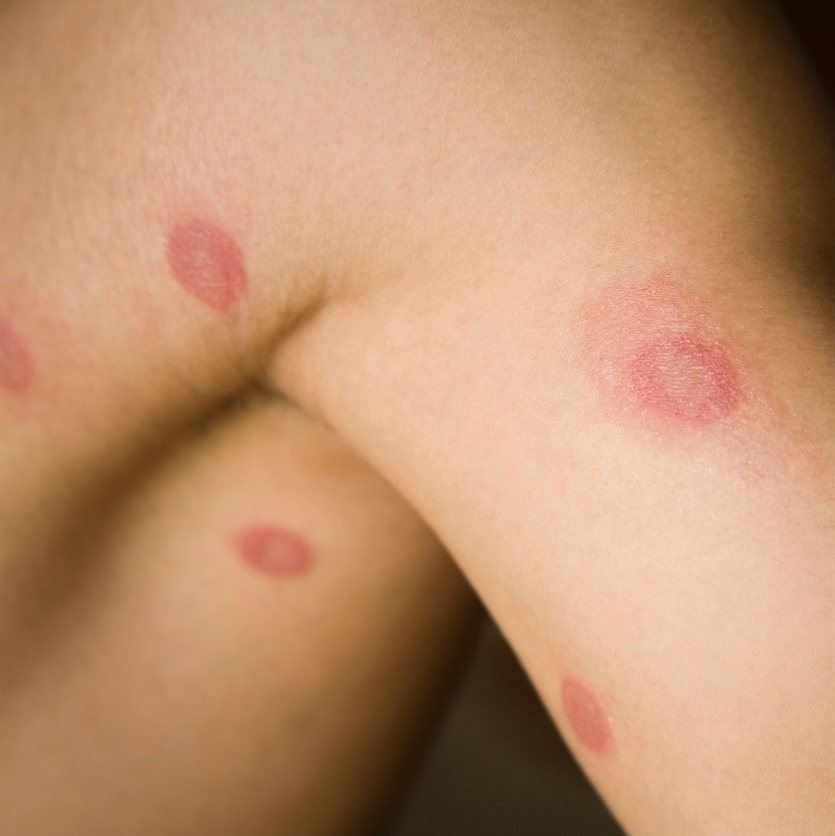 Micose Pega De Uma Pessoa Para Outra