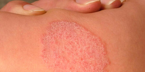 Micose Pega De Uma Pessoa Para Outra