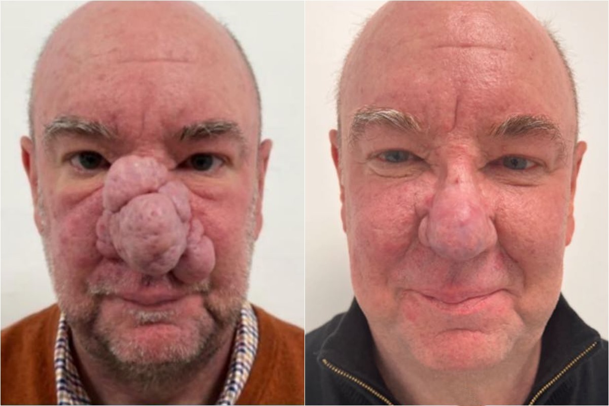 melhores tratamentos para nariz vermelho e inchado