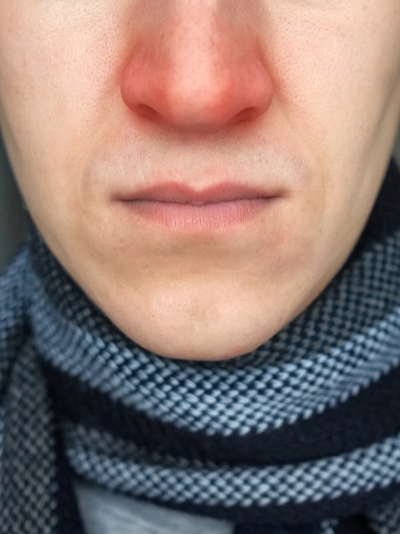 erros comuns ao tratar nariz inchado em casa