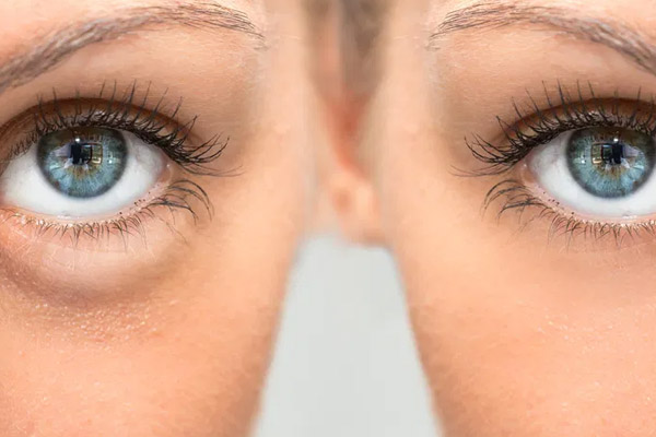 remover olheiras genéticas