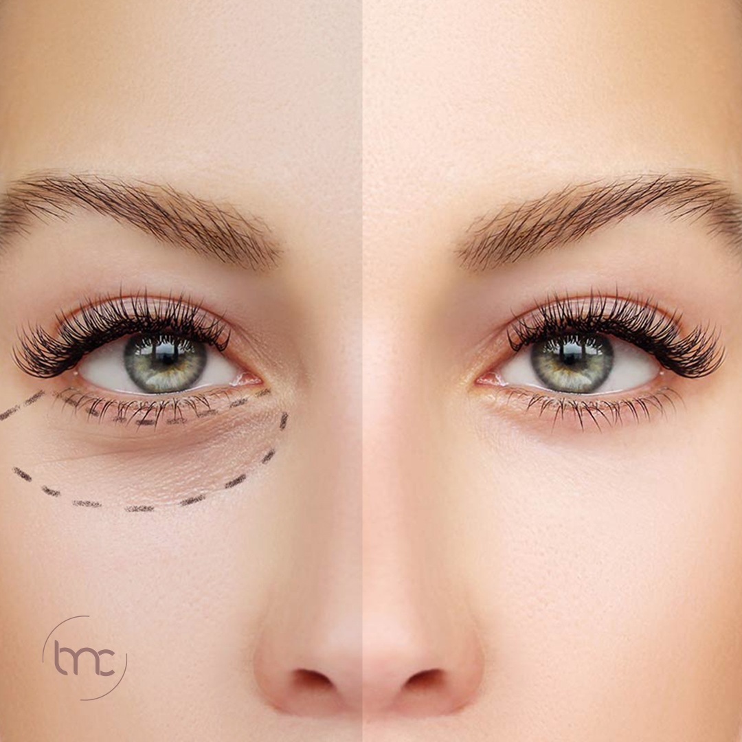 tratamento para olheiras escuras