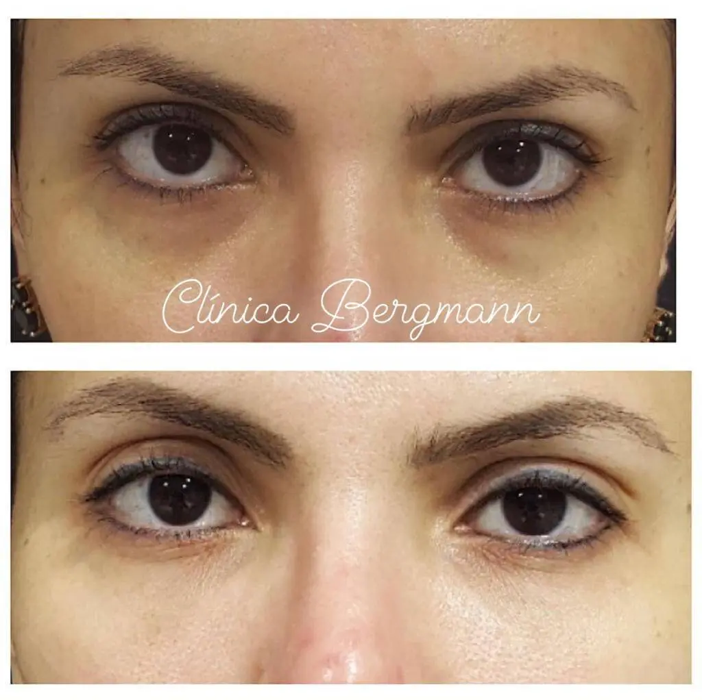 remover olheiras genéticas