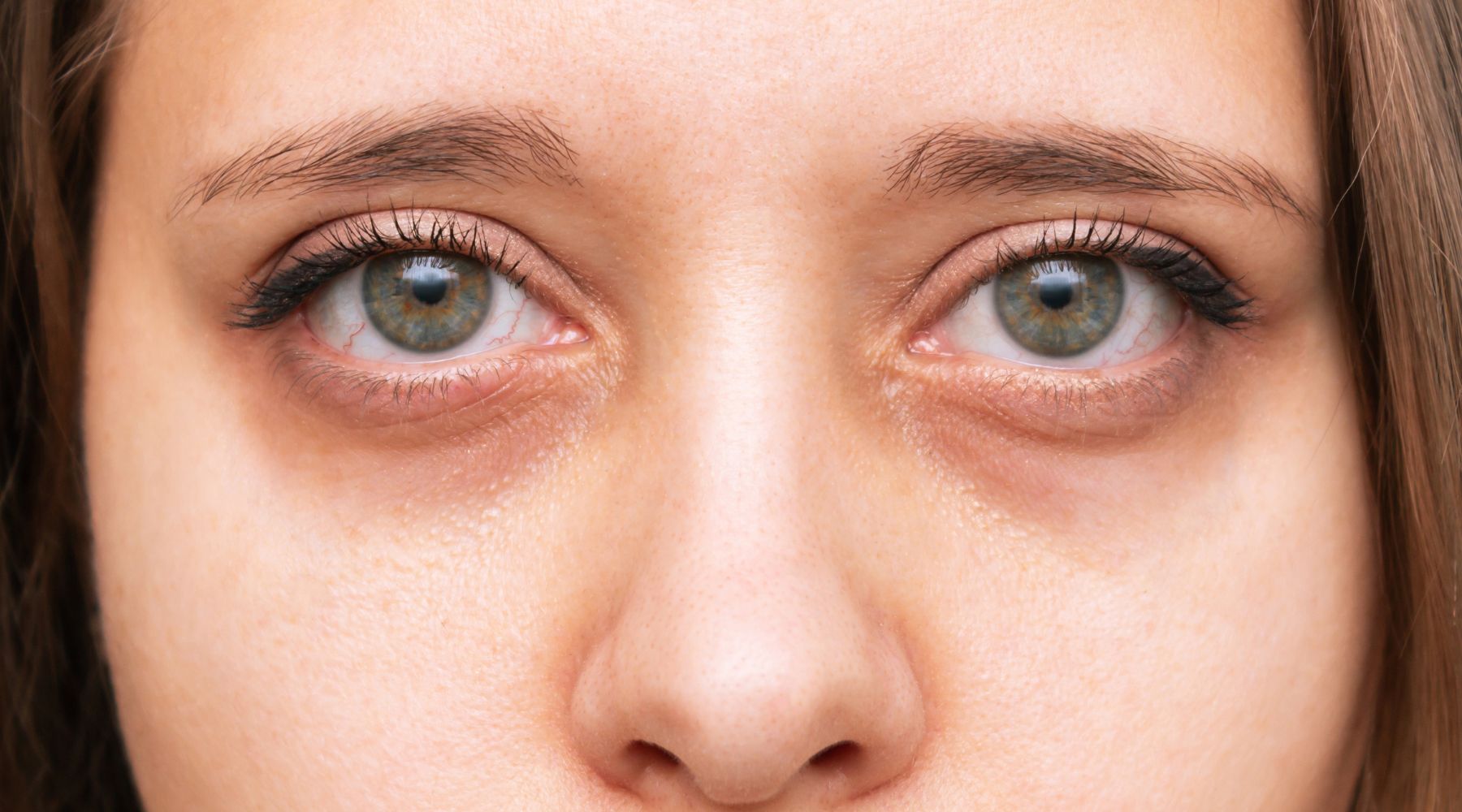 remover olheiras genéticas