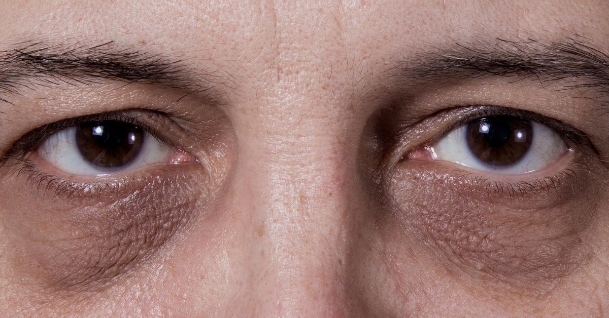 tratamento para olheiras escuras