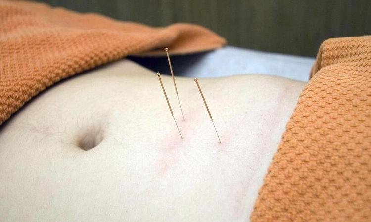 Onde Fazer Acupuntura De Graça