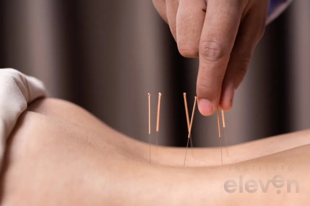 Onde Fazer Acupuntura De Graça