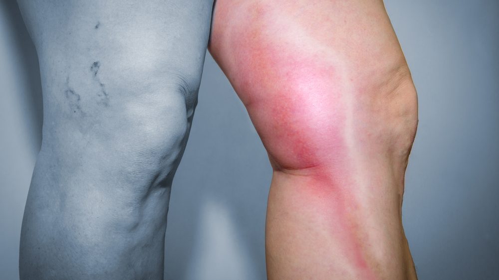 sintomas de flebite nas pernas