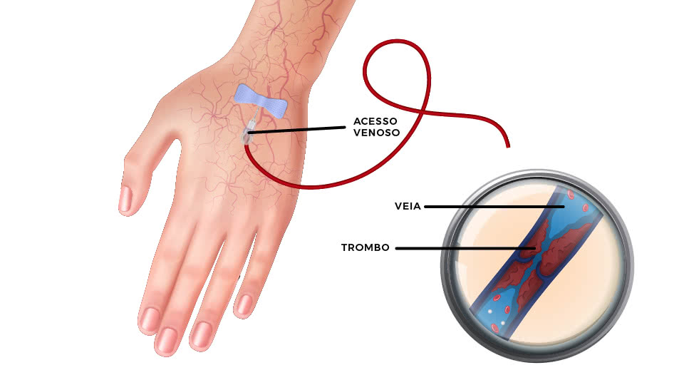 flebite superficial sintomas