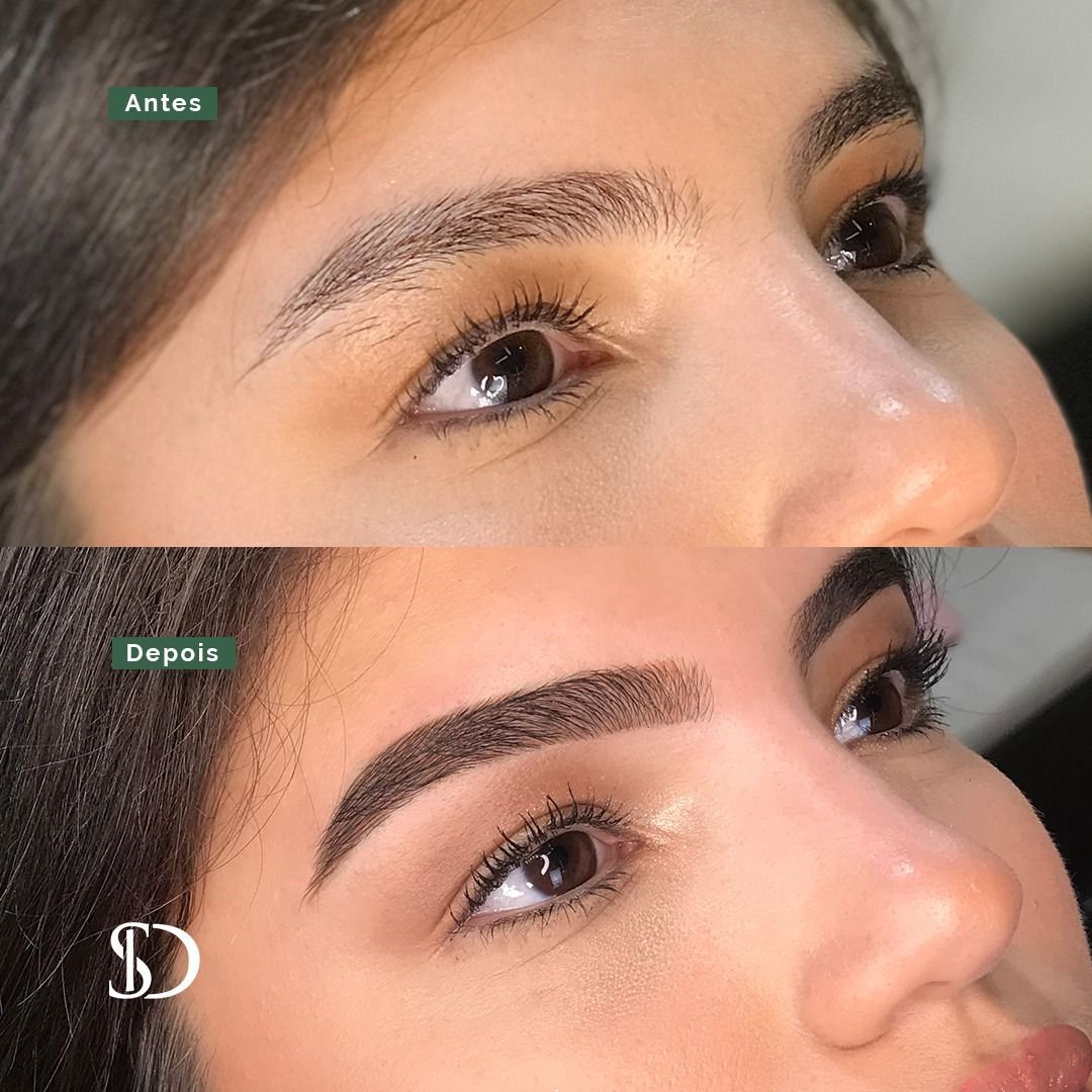 Laser para Sobrancelhas: Despigmentação vs. Depilação