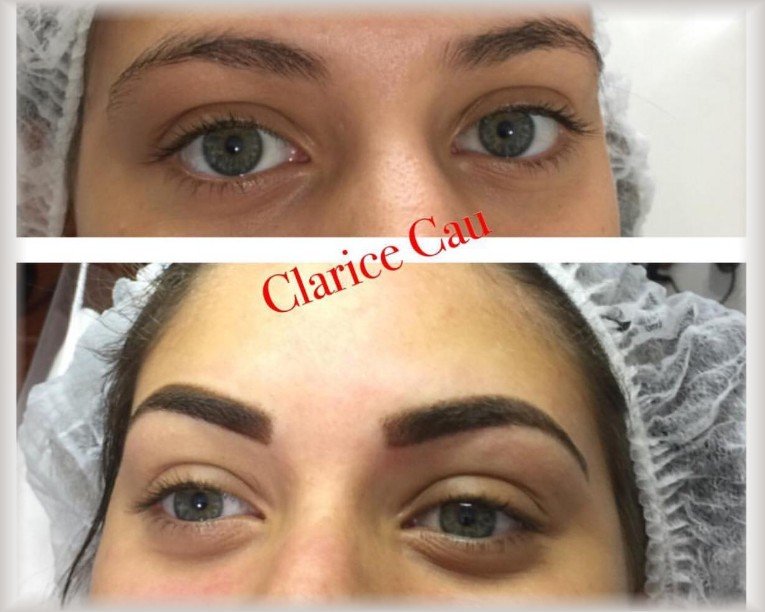 Quanto Custa Remover Micropigmentação com Laser?